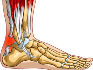 Achilles Tendon Surgery