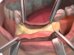 Bone Grafting