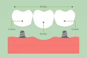  About Dental Bridge 