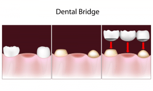 Dental Bridge