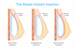  About Breast Implant 