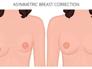 Breast Lift