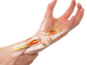 Carpal Tunnel Surgery