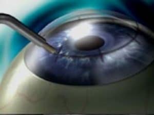 Conductive Keratoplasty