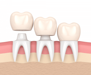 Dental Crown