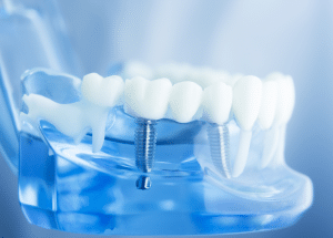 About Dental implant 