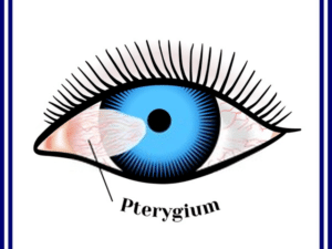 Pterygium Surgery