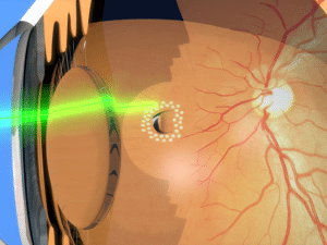 Retinal Detachment