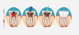 Root Canal