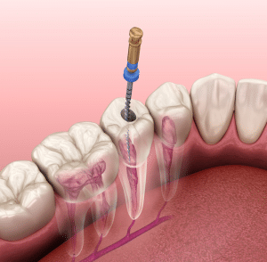  About Root Canal 