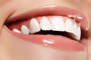 Teeth whitening