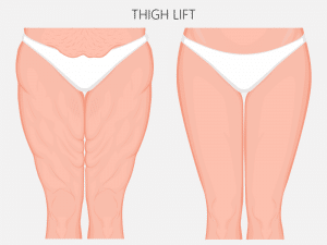  About Thigh Lift 