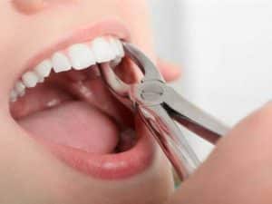 Tooth Extraction