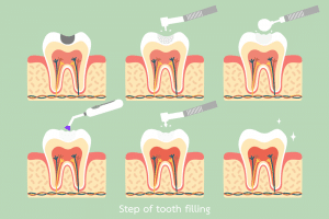  About Dental Filling 