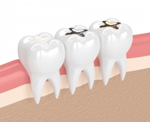 Dental Filling