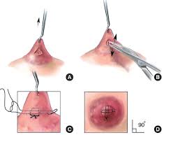 nipple correction