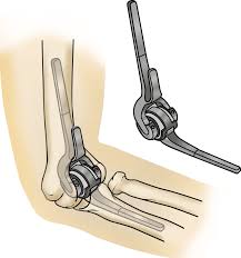 Elbow Replacement