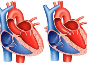 Aortic Valve Replacement