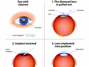 Cataract Surgery