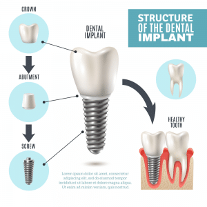  During Dental implant 