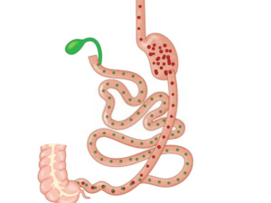 Duodenal Switch