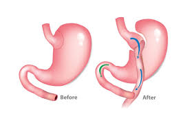 Gastric Bypass
