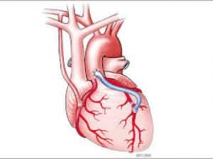 Heart Bypass Surgery