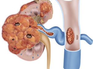 Nephrectomy