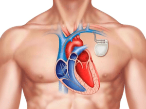 Pacemaker Surgery