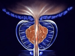 Prostatectomy