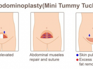 About Tummy Tuck 