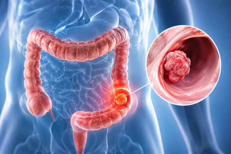 Colon Cancer in Iran