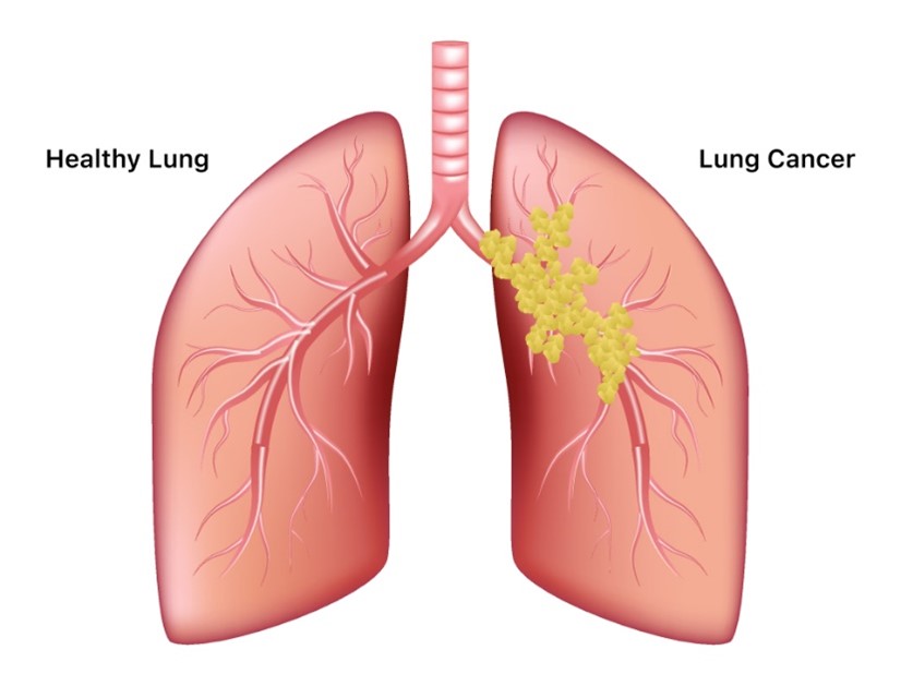 Best Lung Cancer Treatment Hospitals in Iran