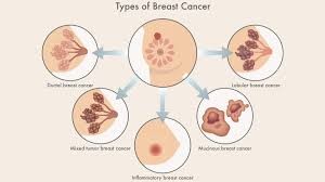 Types of Breast Cancer Treatment in Iran