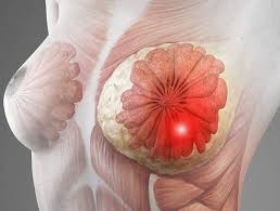 breast cancer