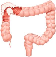 Colon Cancer in Iran