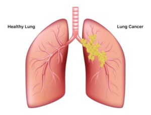 Top Lung Cancer Specialists in Iran
