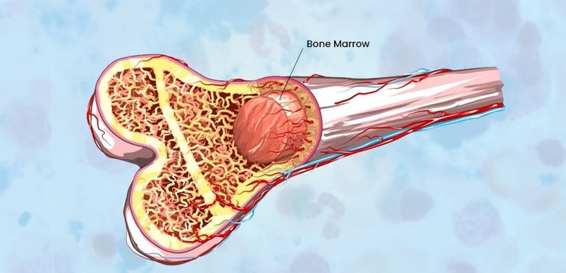 Bone marrow transplant in Iran