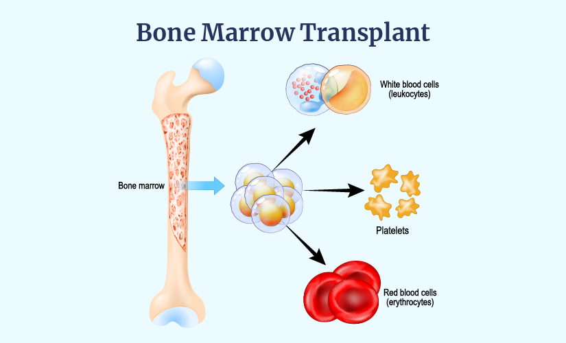 During Bone Marrow Transplant