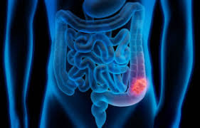 Why Travel to Iran for Colon Cancer Treatment?