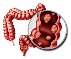 Best Colon Cancer Treatment Hospitals in Iran